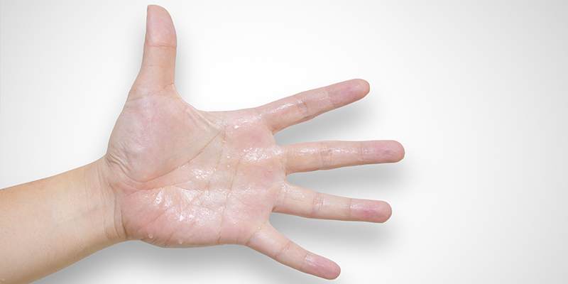 Hiperhidrosis palmar en la mano