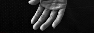 Hiperhidrosis palmar
