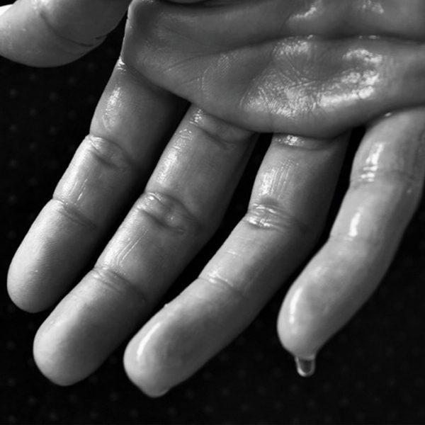 Hiperhidrosis palmar