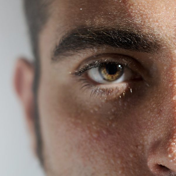 Hiperhidrosis facial